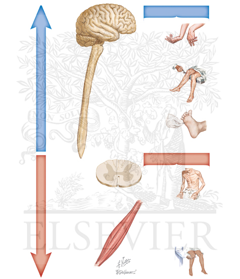 Watermarked preview of unlabeled image: CLINICAL SPECTRUM OF UPPER AND LOWER MOTOR NEURON INVOLVEMENT