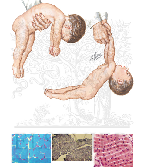 Watermarked preview of unlabeled image: Neonatal Hypotonia