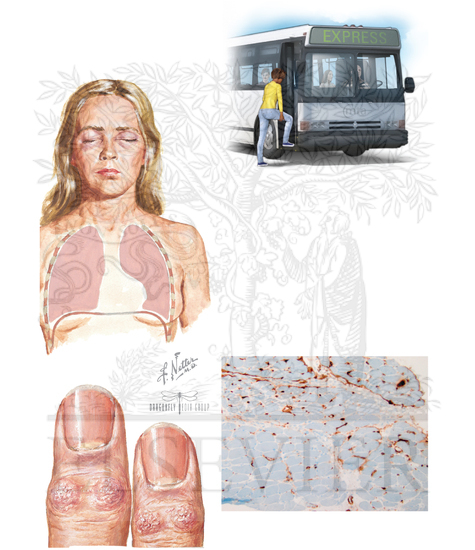 Watermarked preview of unlabeled image: Other Types of MuscularDystrophy: Polymyositis and Dermatomyositis