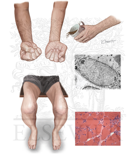 Watermarked preview of unlabeled image: Inclusion Body Myositis