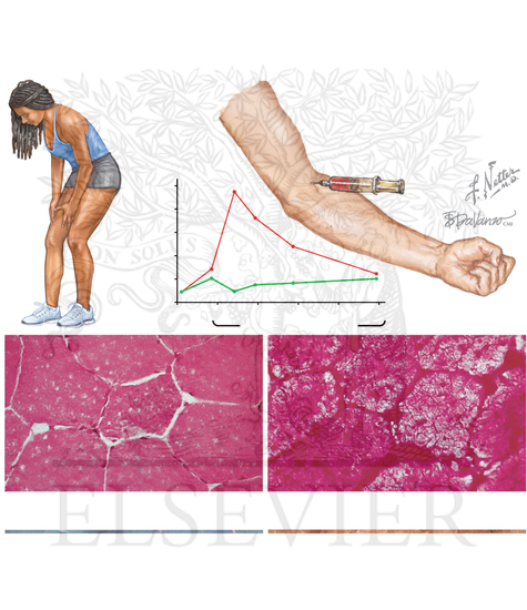 Metabolic and Mitochondrial Myopathies: McARDLE DISEASE
