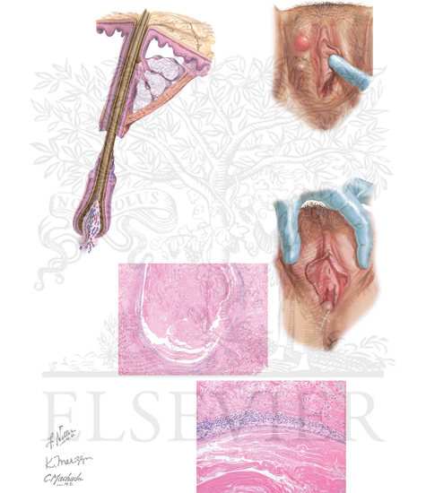 Epidermal Inclusion Cyst