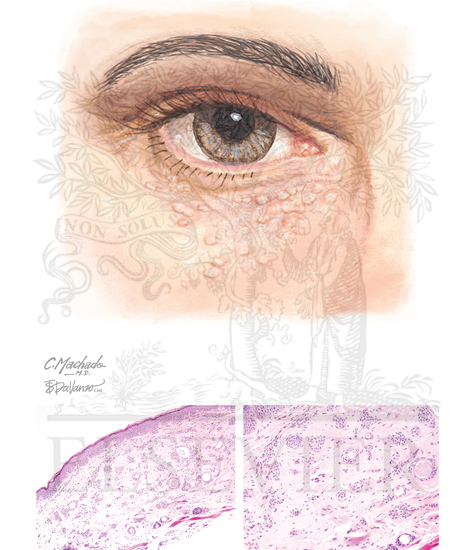 Eccrine Syringoma