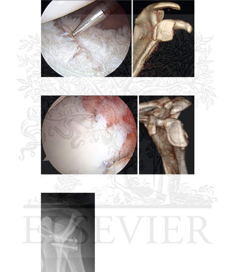 Watermarked preview of unlabeled image: Posterior Dislocation of the Glenohumeral Joint (Continued)