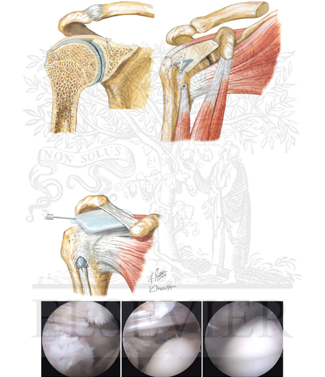 Watermarked preview of unlabeled image: Surgical Management of Irreparable of Supraspinatus and Infraspinatus Cuff Tear