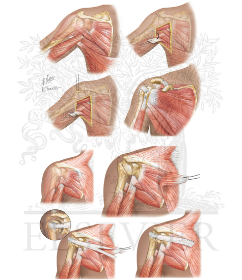 Surgical Management of irreparable of Supraspinatus and Infraspinatus Cuff Tear (Continued)