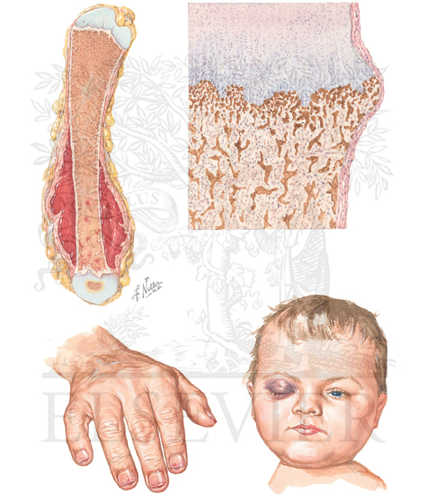 Scurvy: Bony and Skin Abnormalities