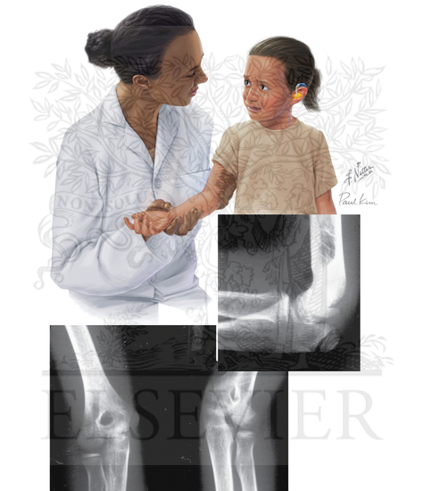 Osteochondritis Dissecans of the Elbow (Panner Disease)