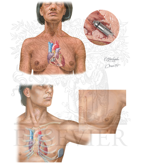 Cardiac Pacing