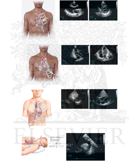 Watermarked preview of unlabeled image: Transthoracic Cardiac Ultrasound: Transducer Positions in Echocardiographic Examination  