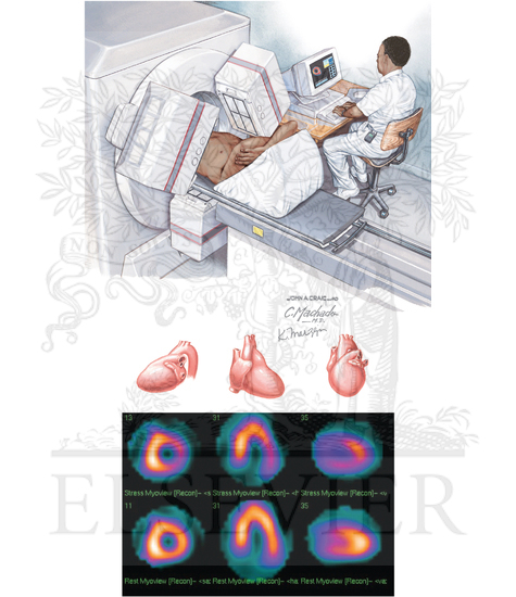 Myocardial Perfusion Imaging