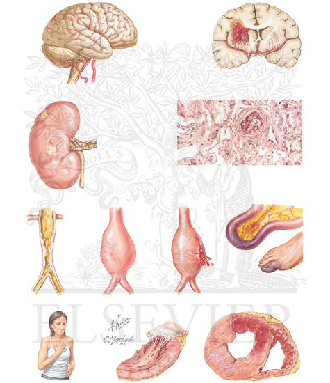 End Organ Damage by Vascular Disease 