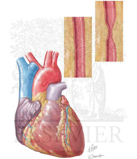 Coronary Artery Spasm 