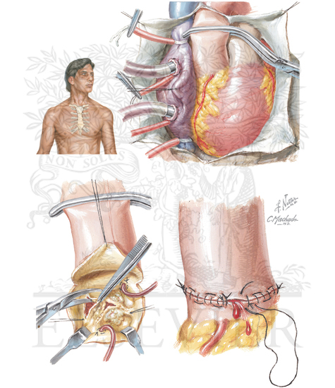 Surgery for Acquired Heart Disease (Valvar Replacement): Aortic Valve Replacement
