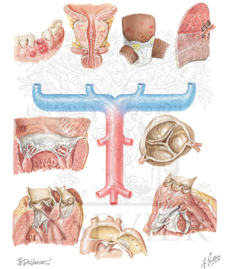 Infectious Endocarditis - Portals of Entry and Predisposing Lesions