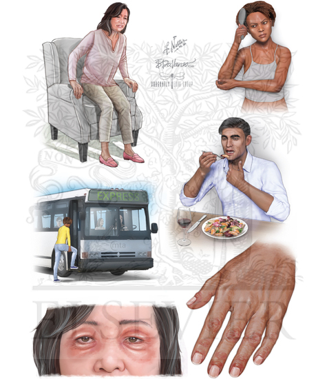 Watermarked preview of unlabeled image: Polymyositis and Dermatomyositis