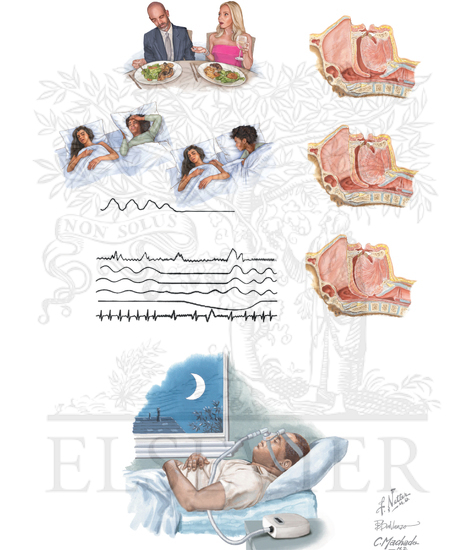 Watermarked preview of unlabeled image: Obstructive Sleep Apnea and Hypertension