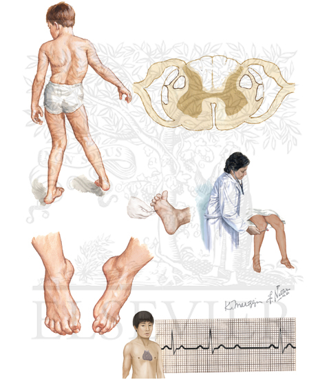 Friedreich’s ataxia