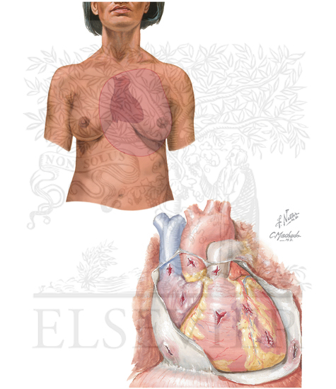 Penetrating Heart Wounds: Relative Distribution