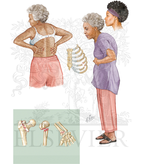 Clinical Manifestations of Osteoporosis