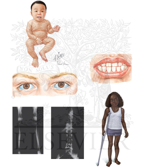 Osteogenesis Imperfecta Type I