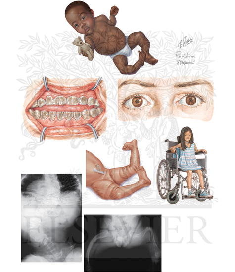 Osteogenesis Imperfecta Type 3
