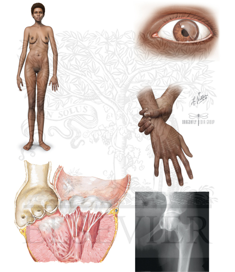 Marfan Syndrome