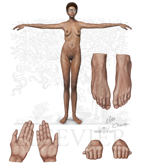 Watermarked preview of unlabeled image: Marfan Syndrome (Continued)