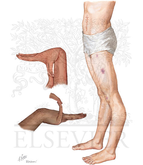 Ehlers-Danlos Syndrome (Continued)
