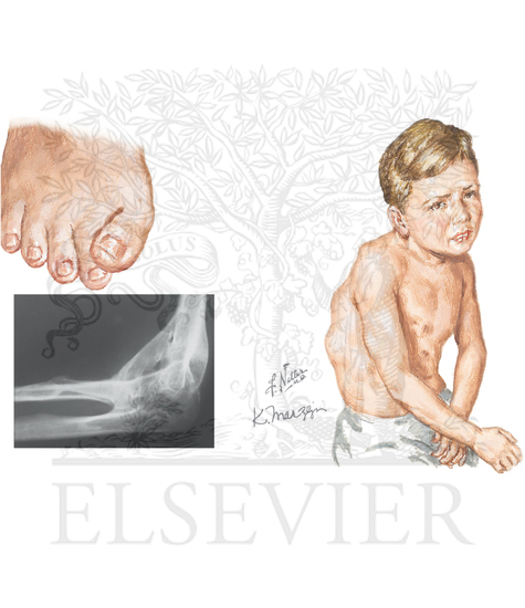Fibrodysplasia Ossificans Progressiva