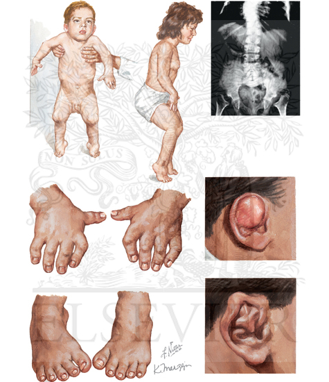 Diastrophic Dwarfism