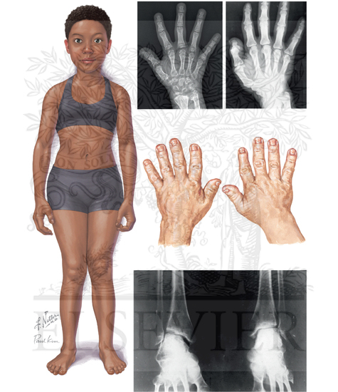 Dwarfism - Multiple Epiphyseal Dysplasia, Fairbank Type