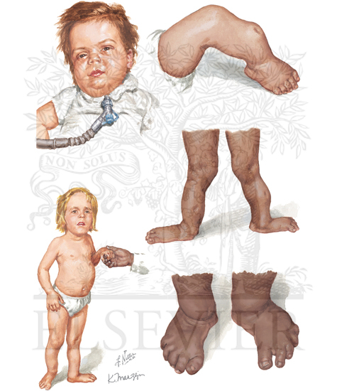 Dwarfism - Camptomelic (Campomelic) Dysplasia