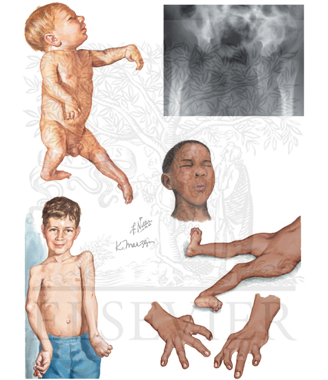 Arthrogryposis Multiplex Congenita