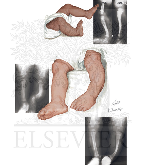 Congenital Bowing of the Tibia