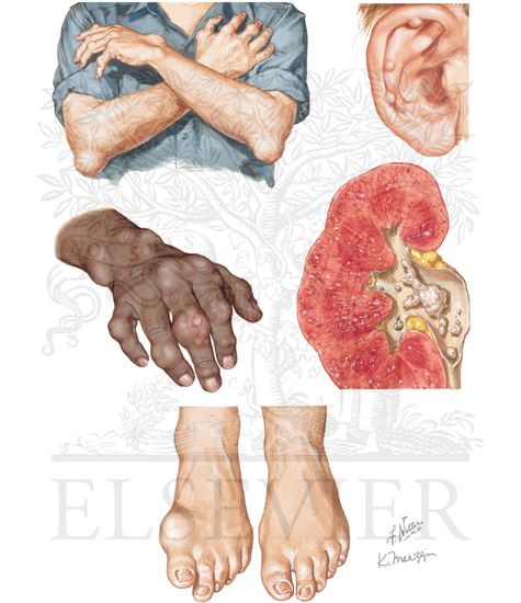 Tophaceous Gout 