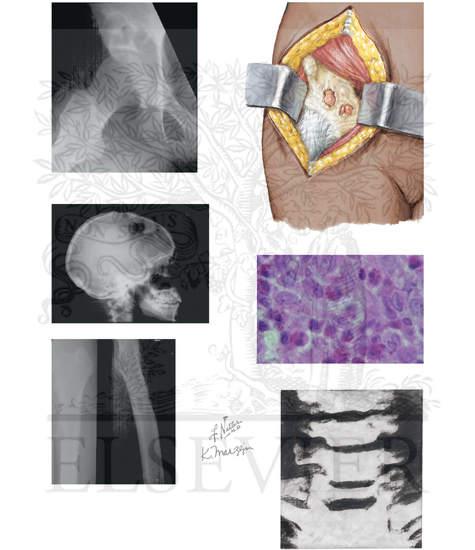 Benign Tumors of Bone: Eosinophilic Granuloma