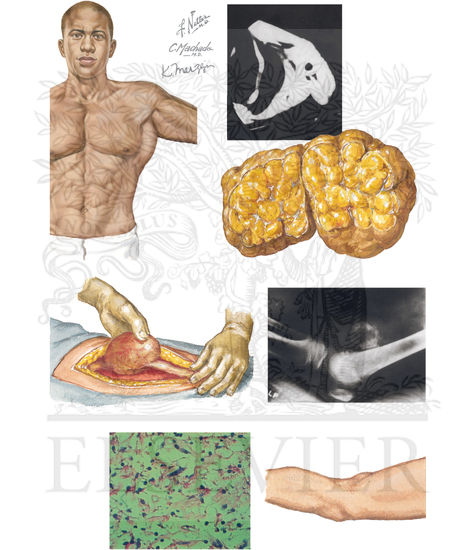 Benign Tumors of Soft Tissue: Lipoma, Schwannoma/Neurofibroma, and Myositis
Ossificans