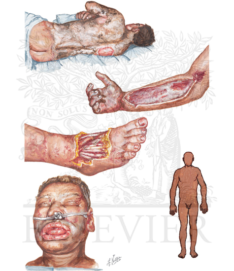 Watermarked preview of unlabeled image: Causes and Clinical Types of Burns