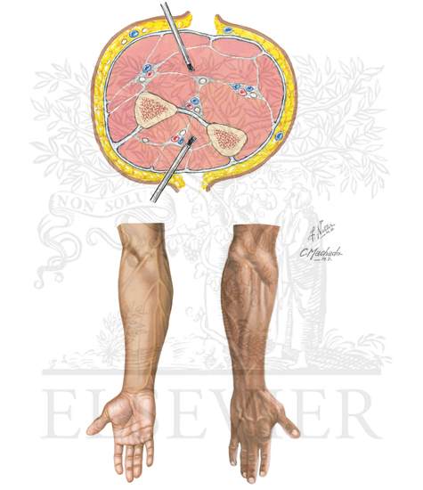 Incisions for Compartment Syndrome of Forearm and Hand
