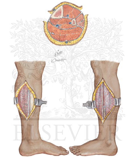 Longitudinal Incision Leg Incisions for Compartment Syndrome of Leg