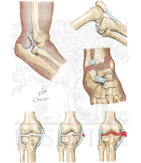 Types of Joint Injury