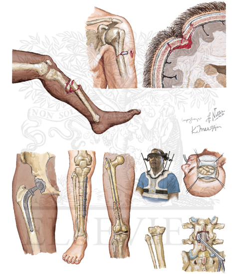 Watermarked preview of unlabeled image: Direct (Nonhematogenous) Causes of Osteomyelitis 