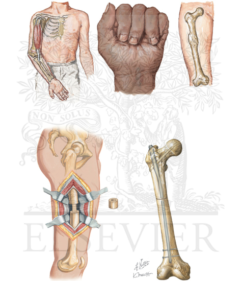 Malunion of Fracture