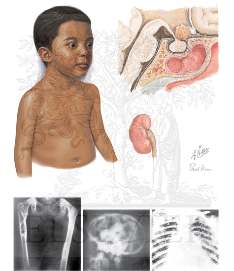 Watermarked preview of unlabeled image: Langerhans Cell Histiocytosis in Children