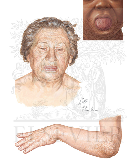 Watermarked preview of unlabeled image: Clinical Manifestations of Hypothyroidism in the Adult (Continued)