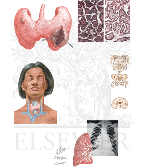 Watermarked preview of unlabeled image: Papillary Thyroid Carcinoma