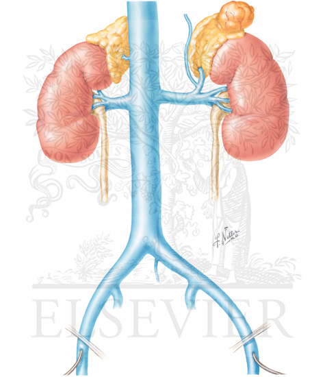Watermarked preview of unlabeled image: Adrenal Venous Sampling for Primary Aldosteronism