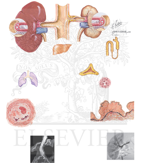 Watermarked preview of unlabeled image: Renin-Angiotensin-Aldosterone System (RAAS) and Renovascular Hypertension