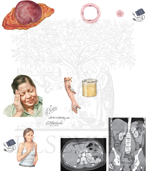 Watermarked preview of unlabeled image: Pheochromocytoma and Paraganglioma 